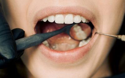 Descubre los Sorprendentes Beneficios del Blanqueamiento Dental