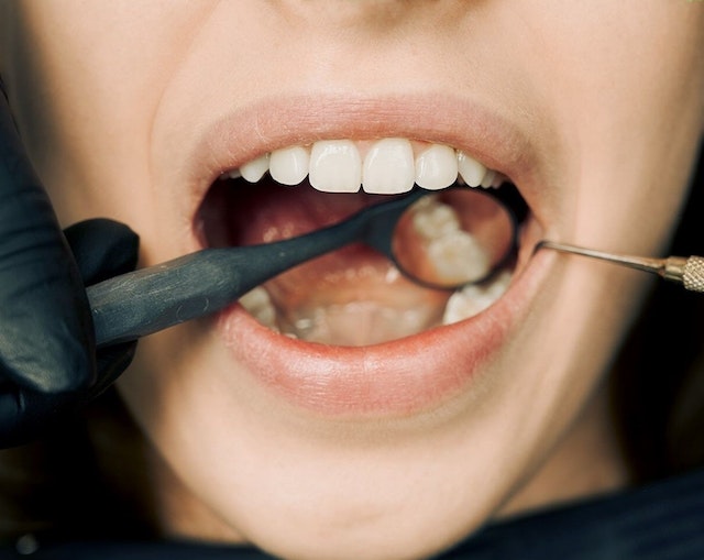 Descubre los Sorprendentes Beneficios del Blanqueamiento Dental