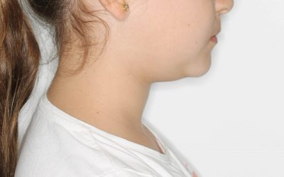 TRATAMIENTO DE LA PROTRUSIÓN MANDIBULAR ¿CUÁNDO? ¿CÓMO? 