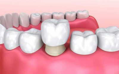 Rehabilitación oral completa